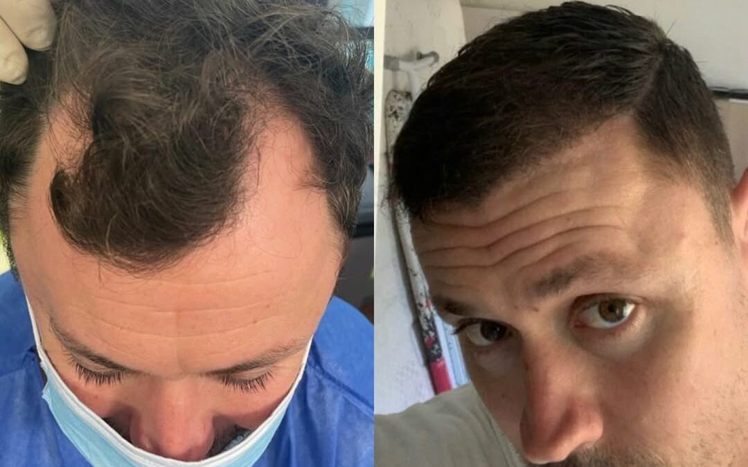 Greffe de cheveux