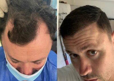 Greffe de cheveux