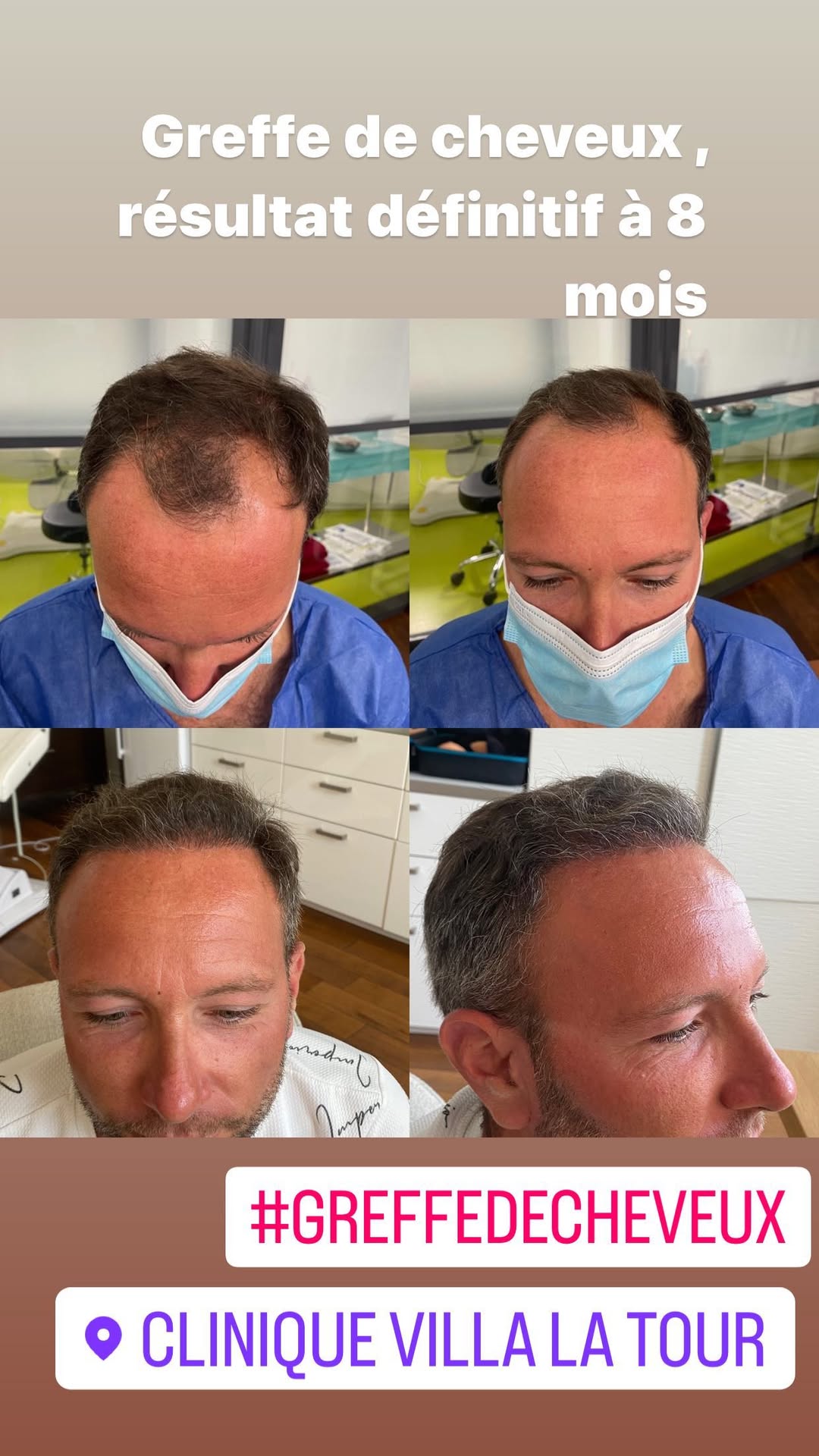 Greffe-cheveux