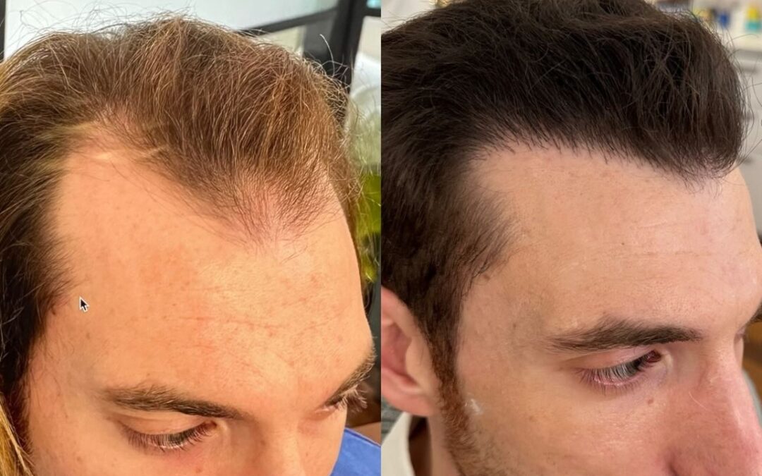 Greffe de cheveux