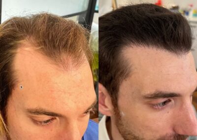 Greffe de cheveux