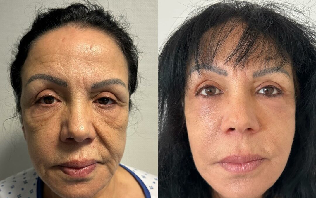 Lifting du visage