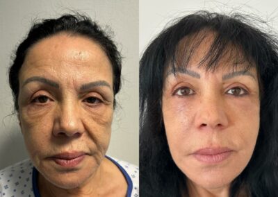 Lifting du visage