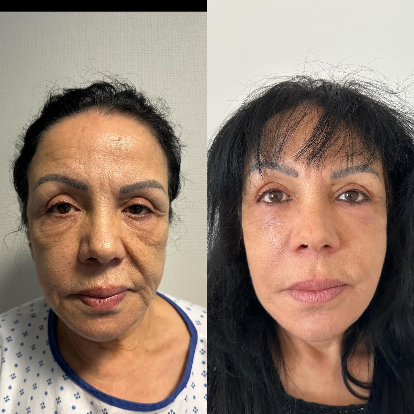 Lifting cervicofacial , lifting centre facial , peeling moyen
