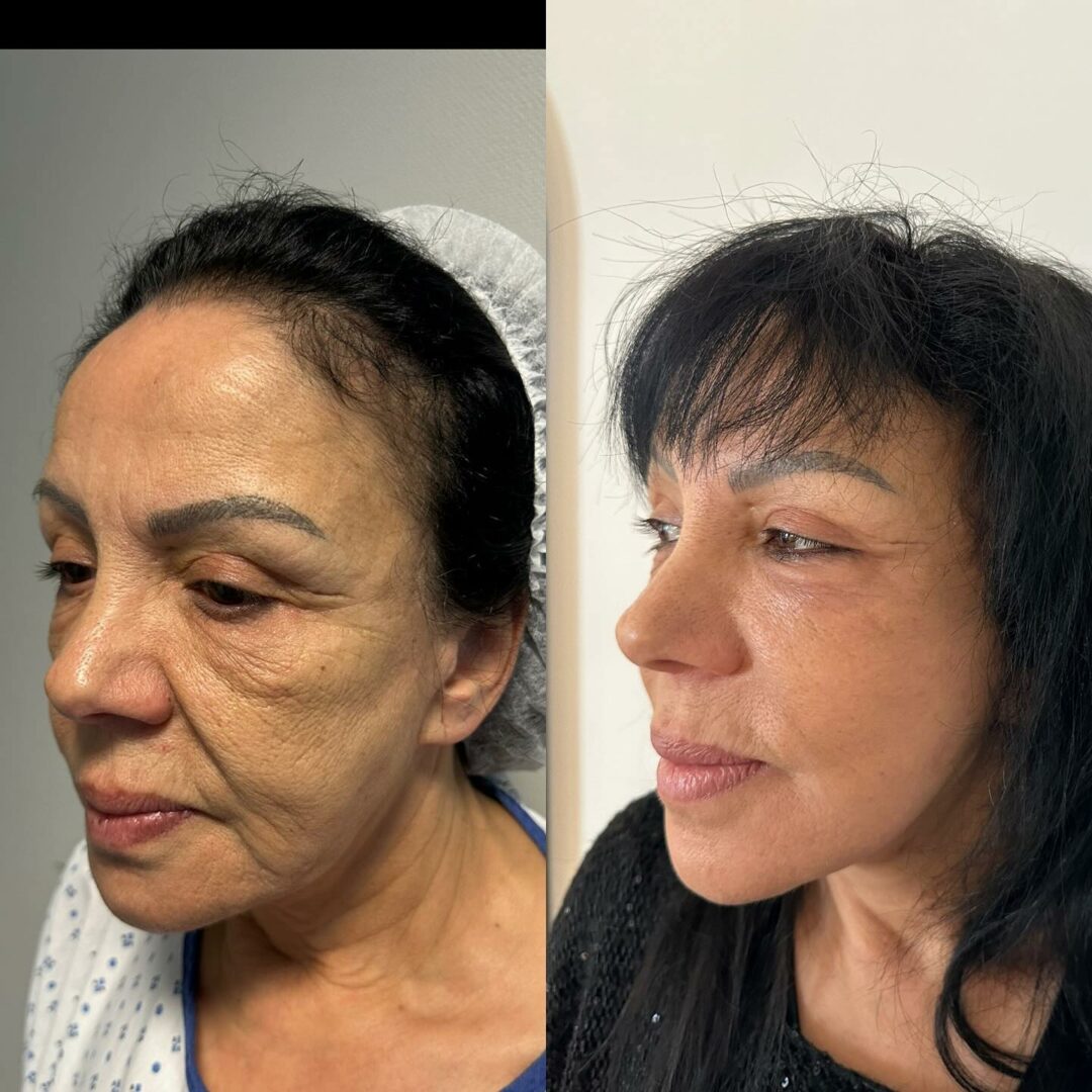Lifting du visage