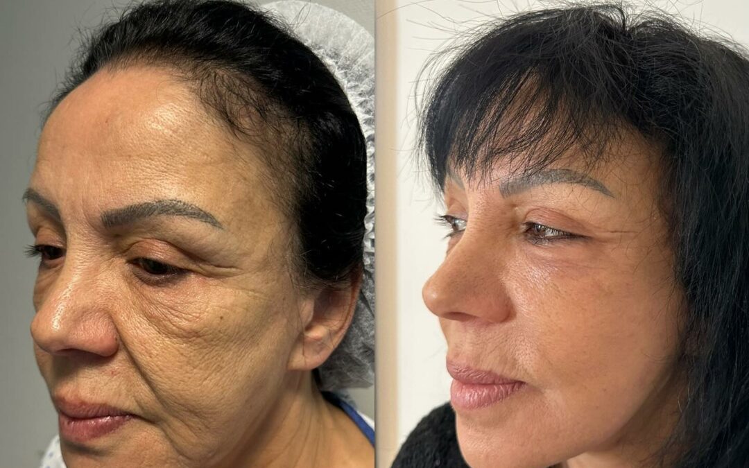 Lifting du visage