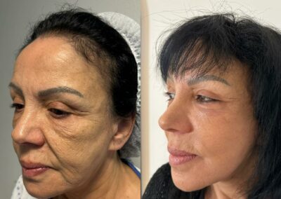 Lifting du visage