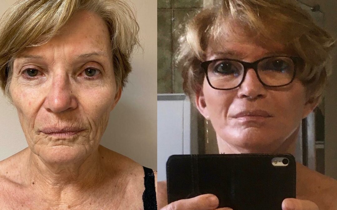 Lifting du visage