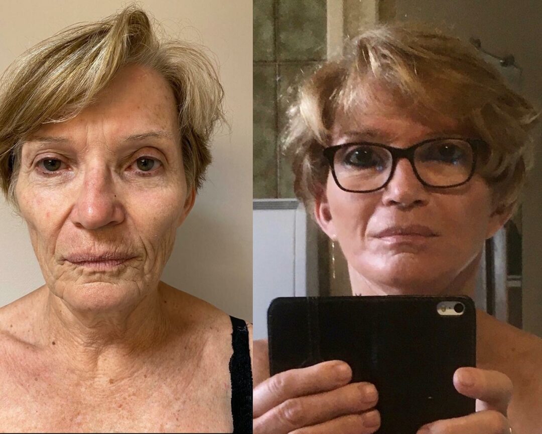 lifting cervico- facial