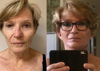 Lifting du visage