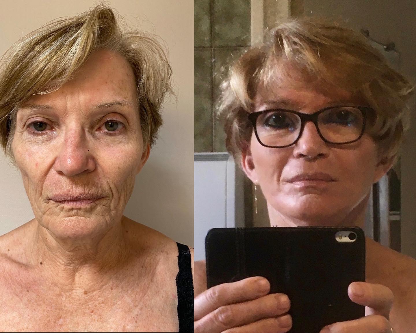 Lifting-intro-3 lifting cervico- facial