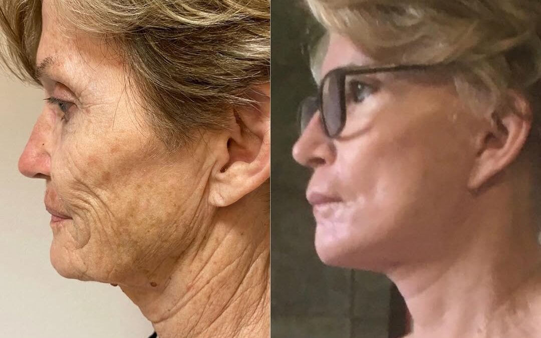 Lifting du visage