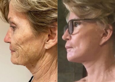 Lifting du visage