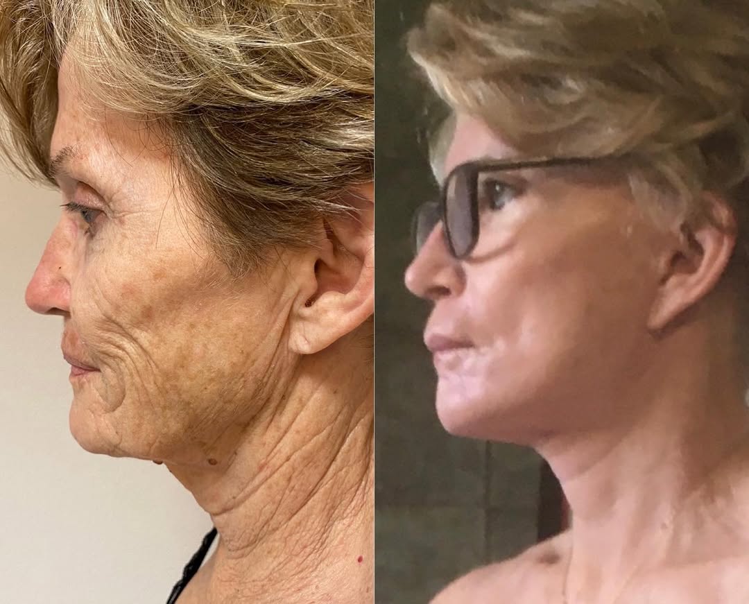 Lifting-intro-4 Blépharoplastie - chirurgie des paupières