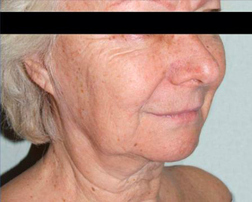 Lifting-intro-5 Lifting cervico- facial