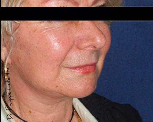 Lifting-intro-6 Lifting cervico- facial