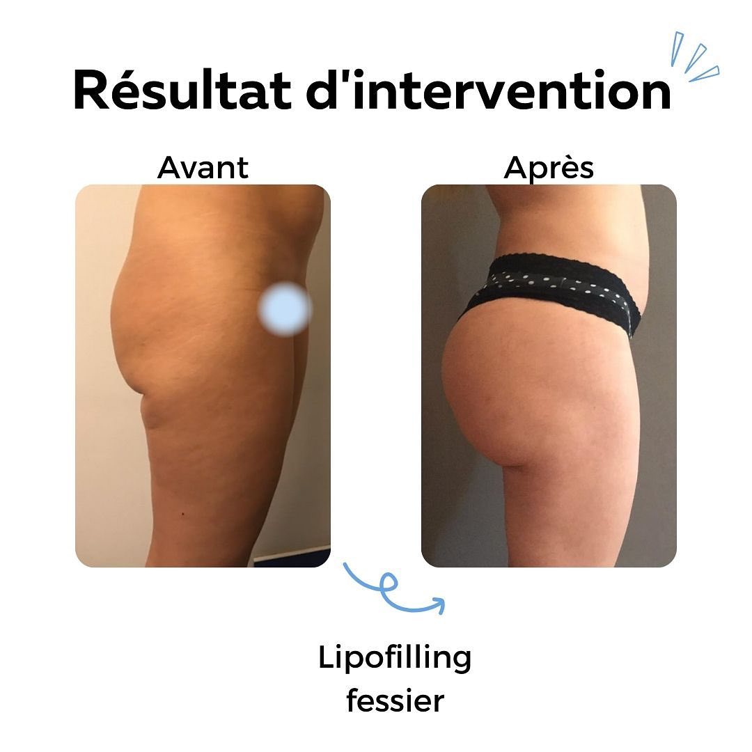 Lipofilling-fesses