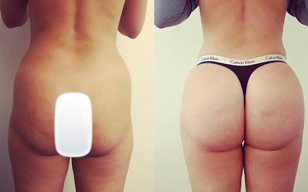 Lipofilling des fesses