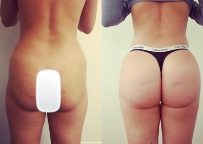 Lipofilling des fesses