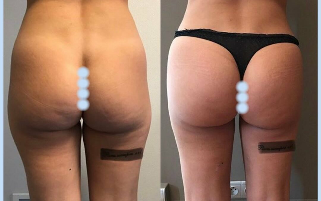 Lipofilling des fesses