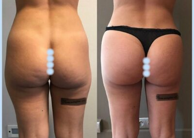 Lipofilling des fesses