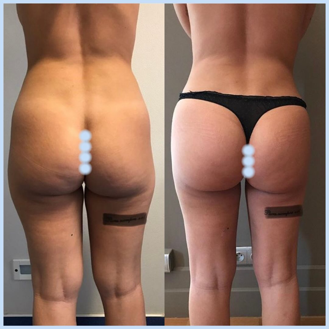 Lipofilling-fesses