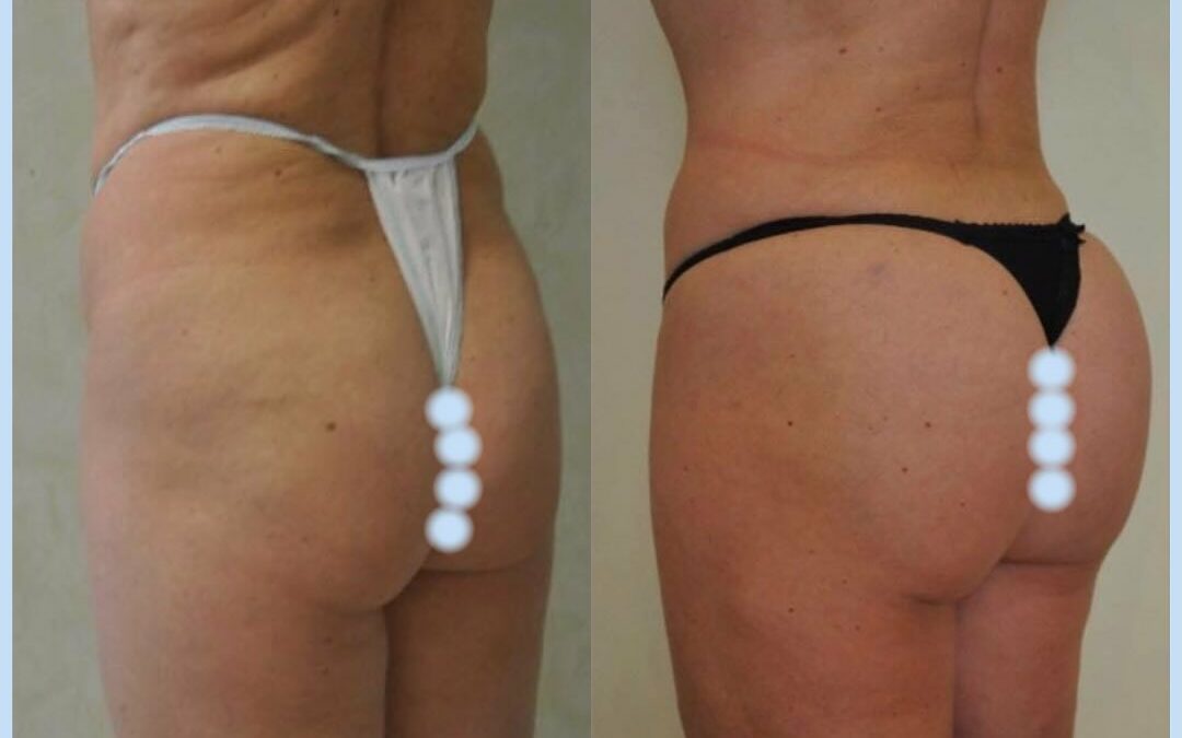 Lipofilling des fesses