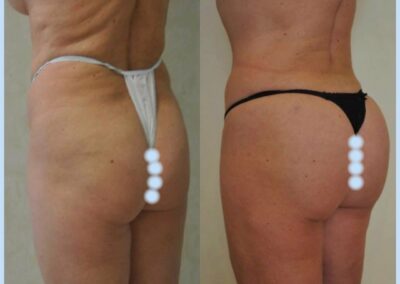 Lipofilling des fesses