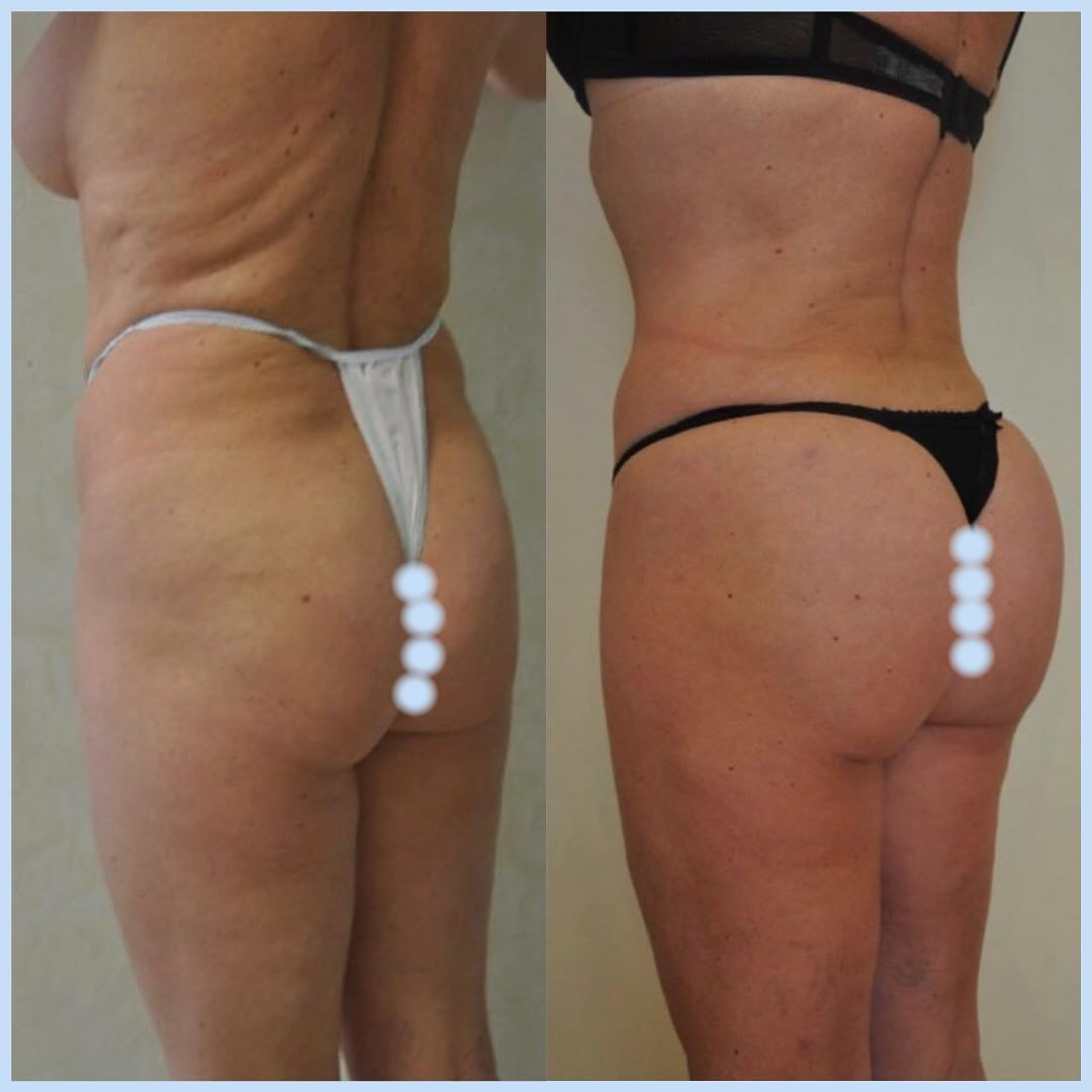Lipofilling-fesses