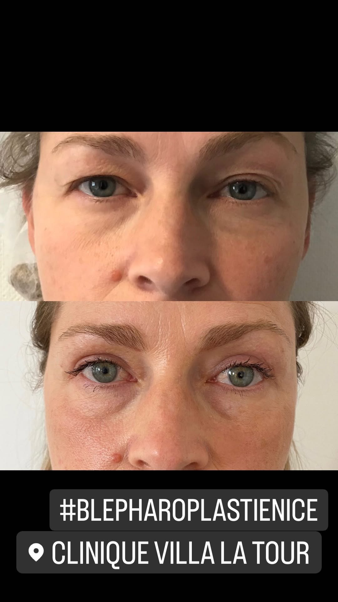 Blépharoplastie - chirurgie des paupières
