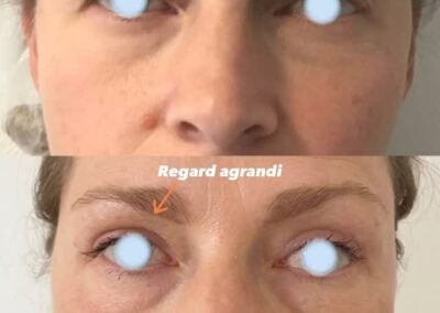 Blépharoplastie