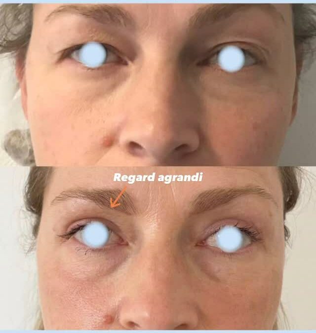 Blépharoplastie