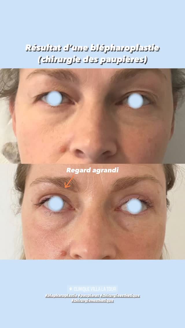 Blépharoplastie - chirurgie des paupières