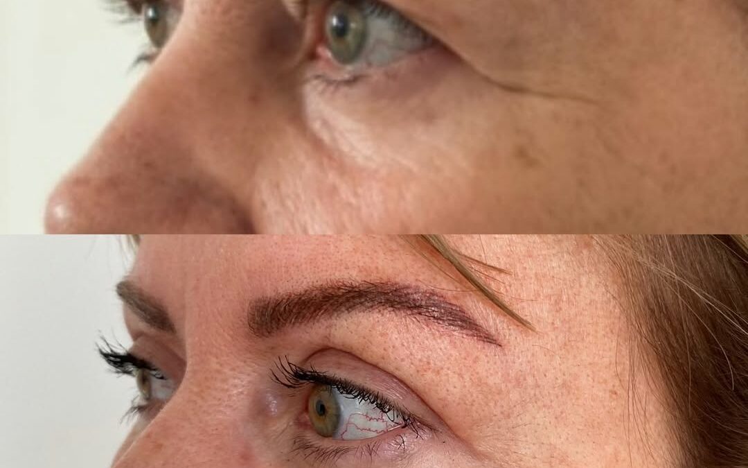Blépharoplastie