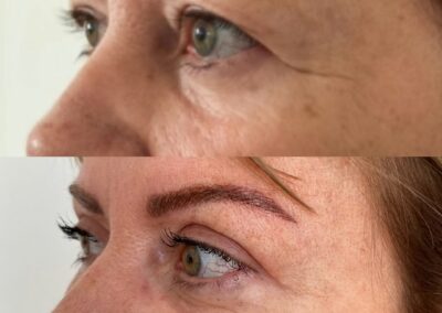 Blépharoplastie