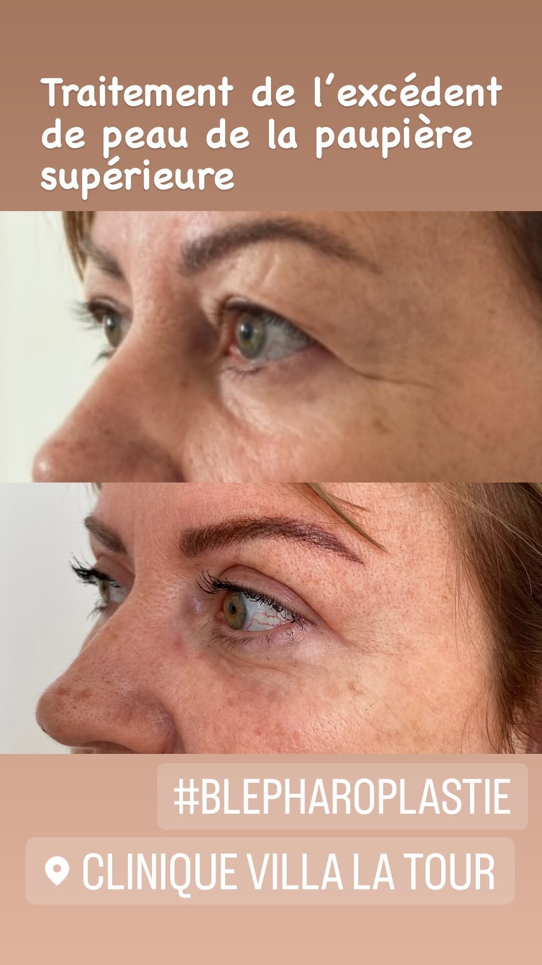 Blépharoplastie - chirurgie des paupières