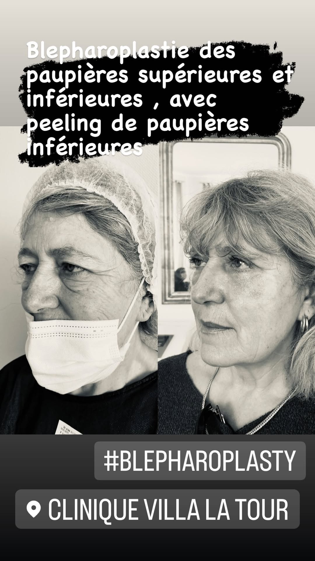 Blépharoplastie - chirurgie des paupières
