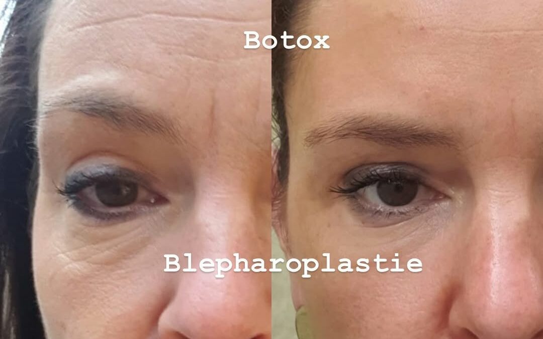 Blépharoplastie