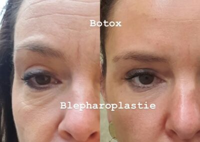 Blépharoplastie