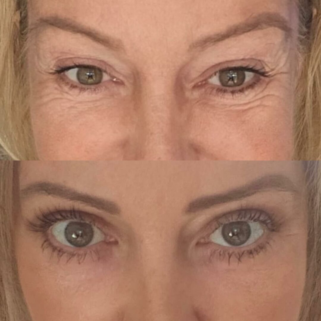 Blépharoplastie - chirurgie des paupières