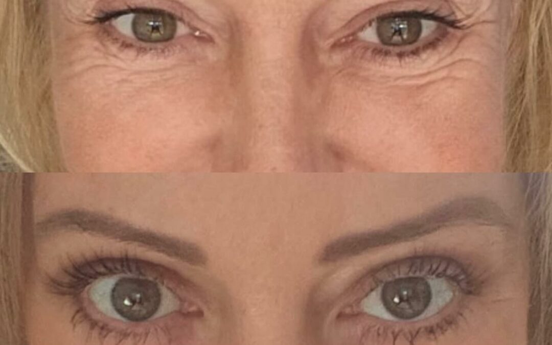 Blépharoplastie