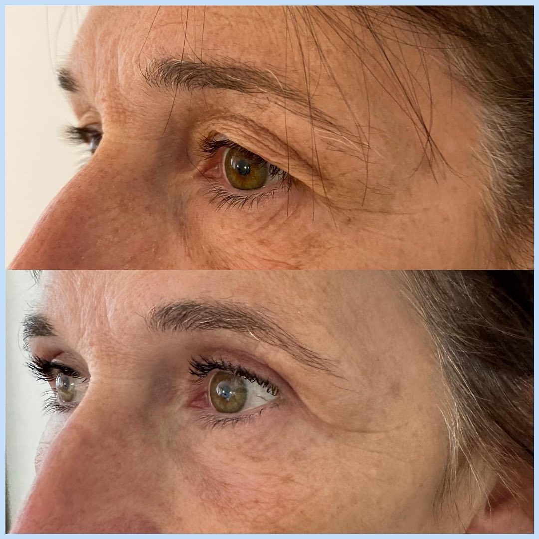blepharoplastie-intro-2 Blépharoplastie - chirurgie des paupières