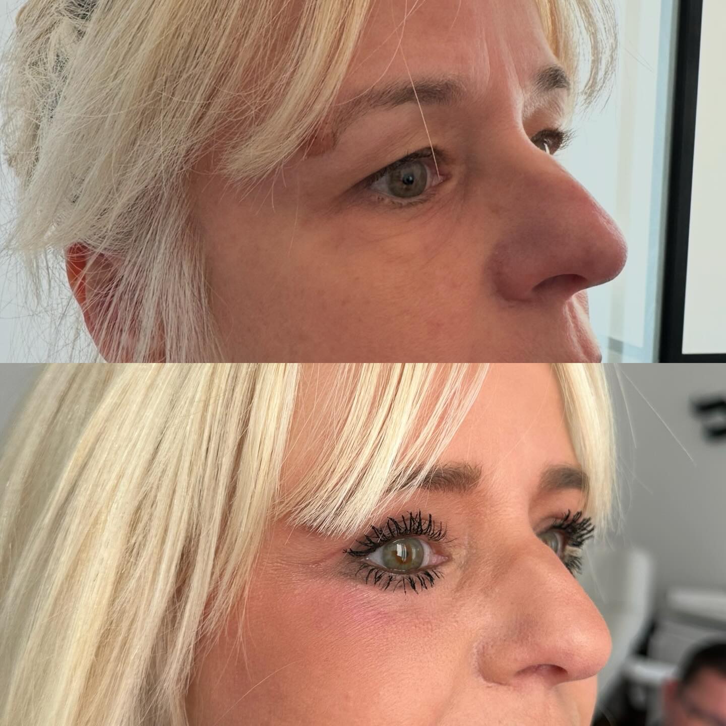 blepharoplastie-intro-3 Blépharoplastie - chirurgie des paupières