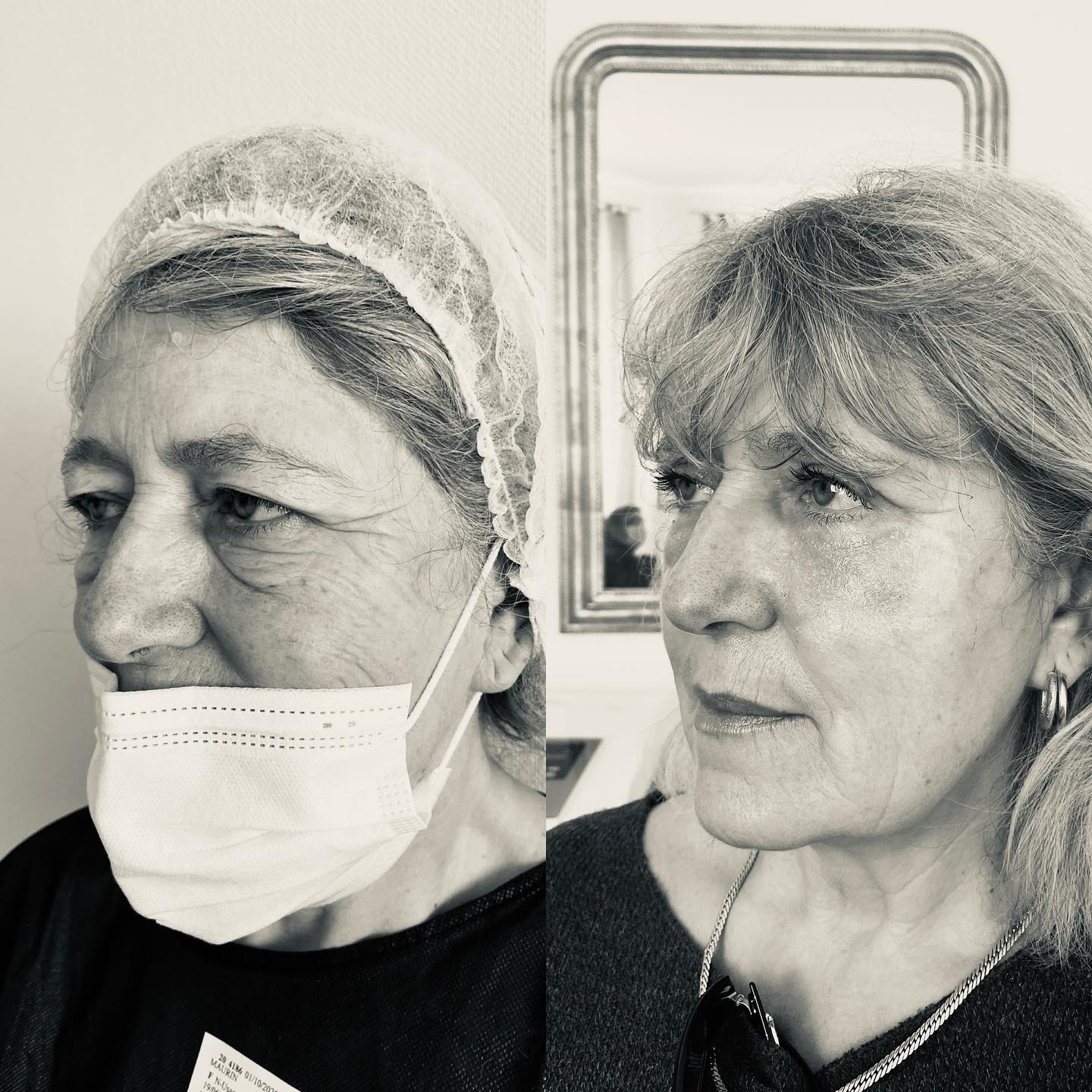 blepharoplastie-intro-4 Blépharoplastie - chirurgie des paupières