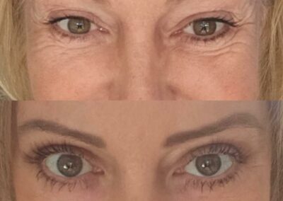 Blépharoplastie