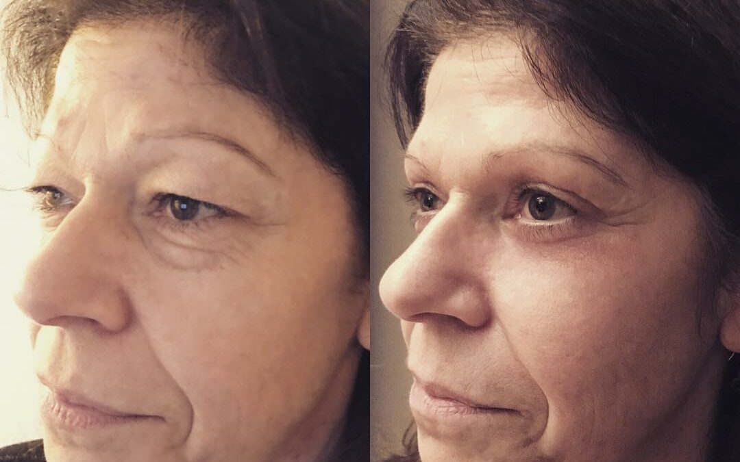 Blépharoplastie