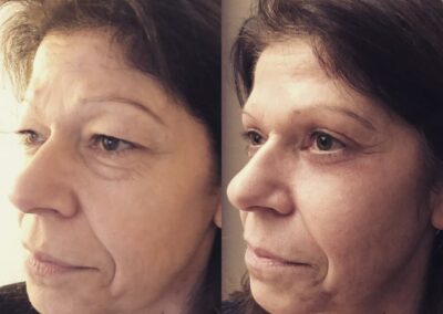 Blépharoplastie