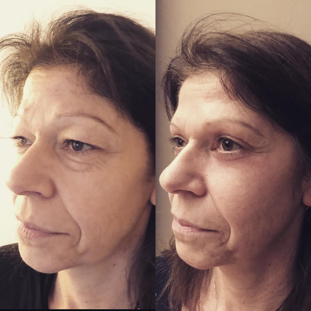 blepharoplastie-intro-5 Blépharoplastie - chirurgie des paupières