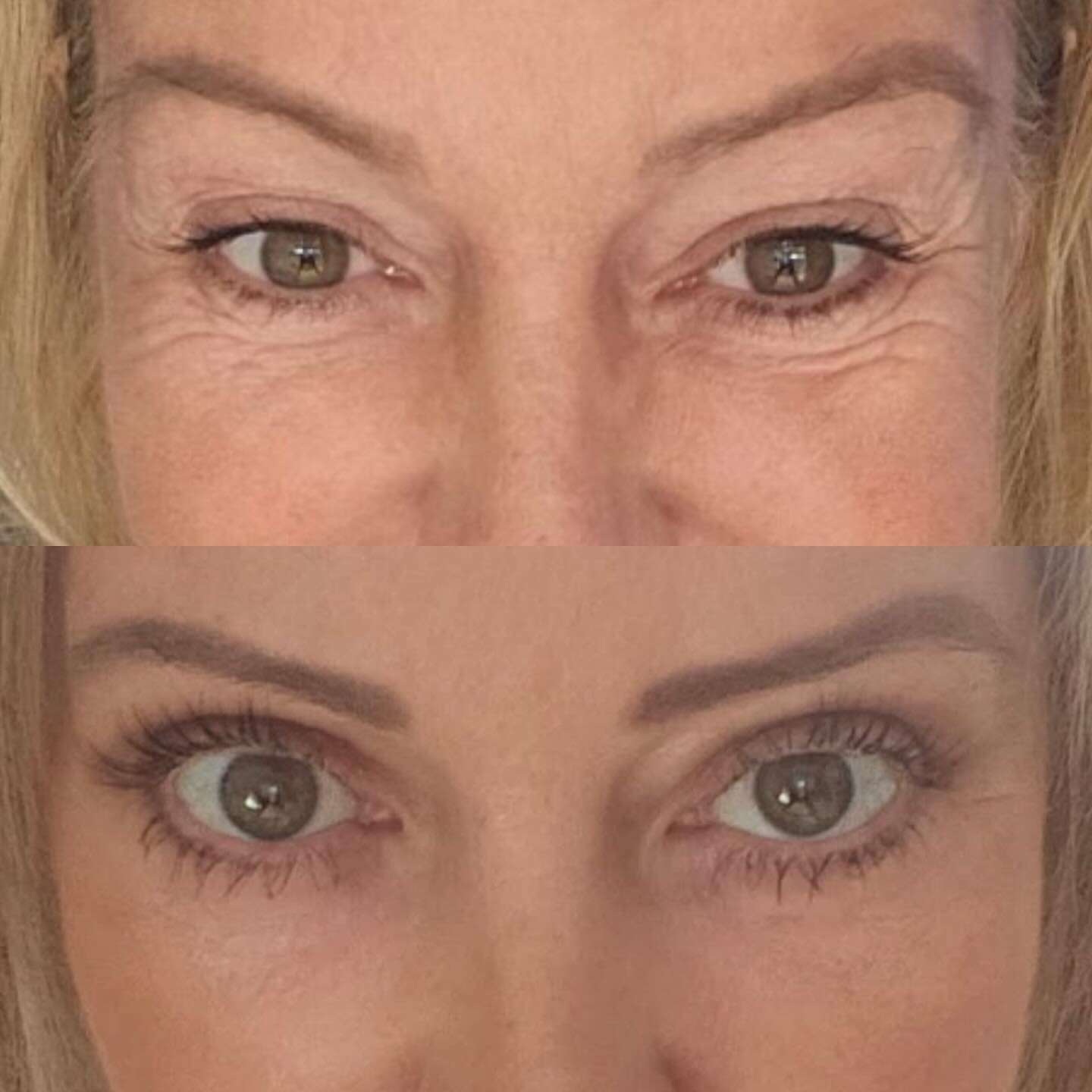 blepharoplastie-intro Blépharoplastie - chirurgie des paupières