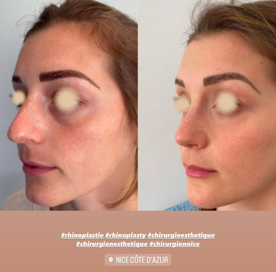 rhinoplastie-1 Rhinoplastie